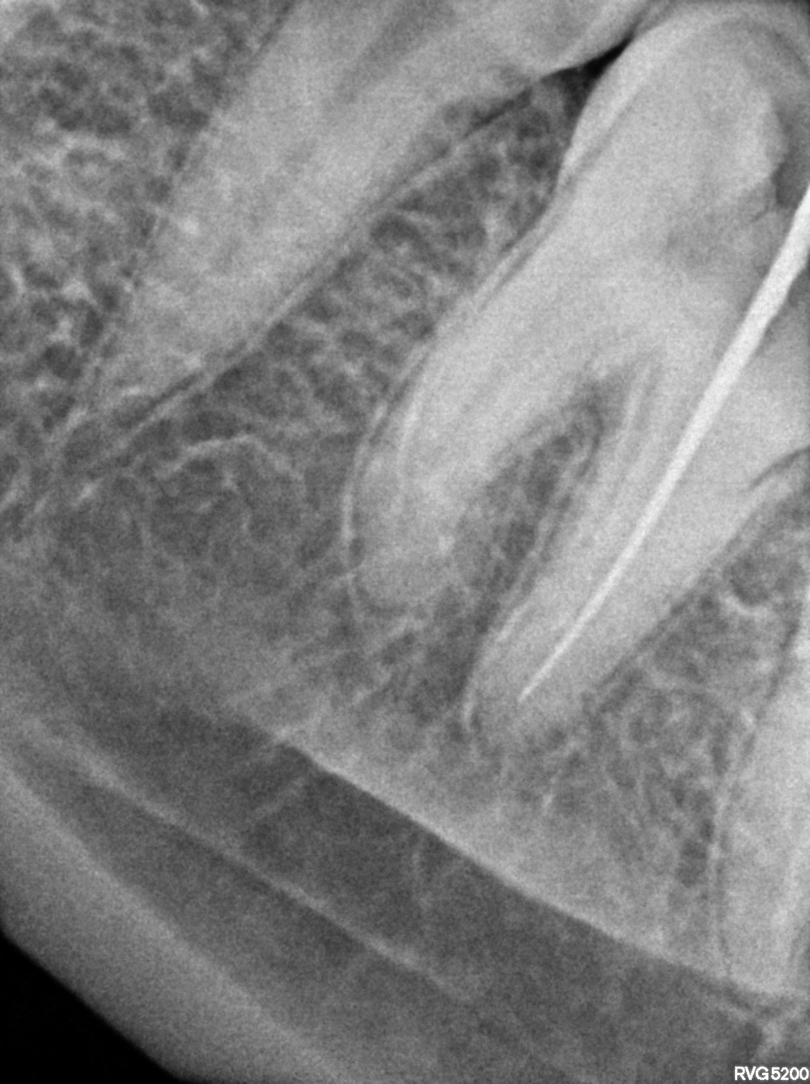 Dental X-ray